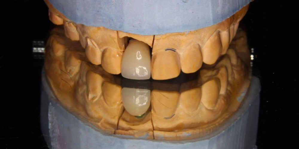 Результат имплантации зуба под ключ после перелома корня зуба - фото №5