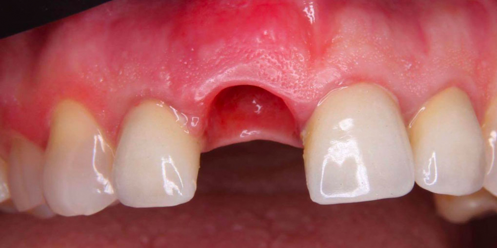Результат имплантации зуба под ключ после перелома корня зуба - фото №6