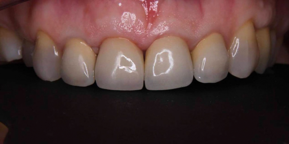 Результат имплантации зуба под ключ после перелома корня зуба - фото №2