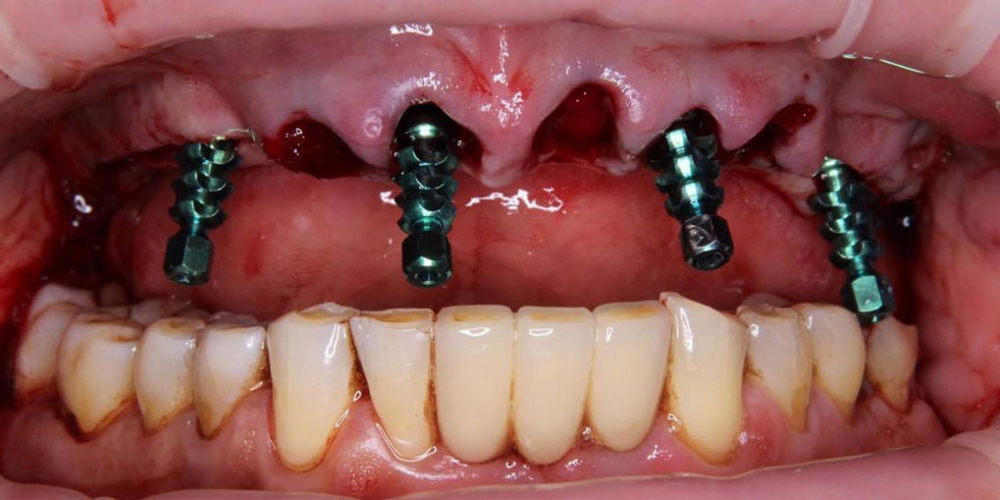 Тотальная реконструкция верхней челюсти с опорой на импланты - фото №6