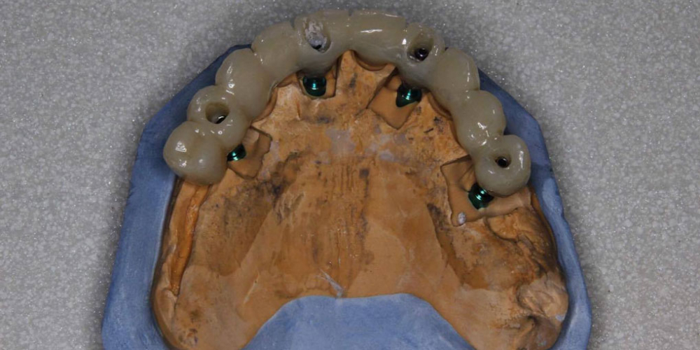 Тотальная реконструкция верхней челюсти с опорой на импланты - фото №8