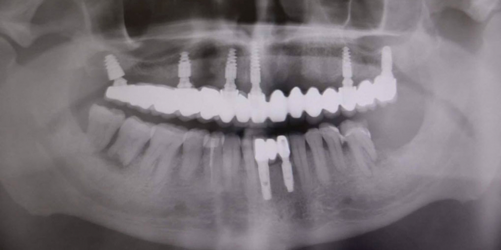 Тотальная реконструкция верхней челюсти с опорой на импланты - фото №2