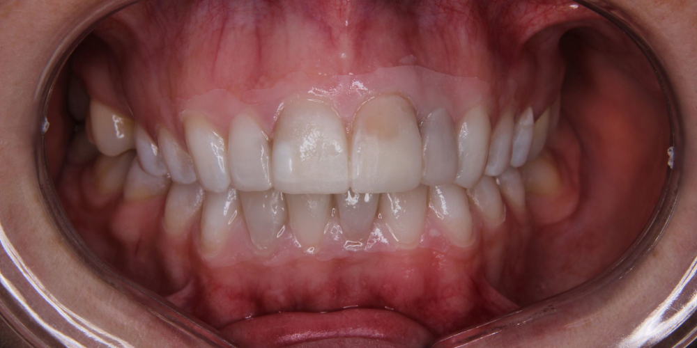 Исправление формы и цвета передних зубов при помощи виниров - фото №1