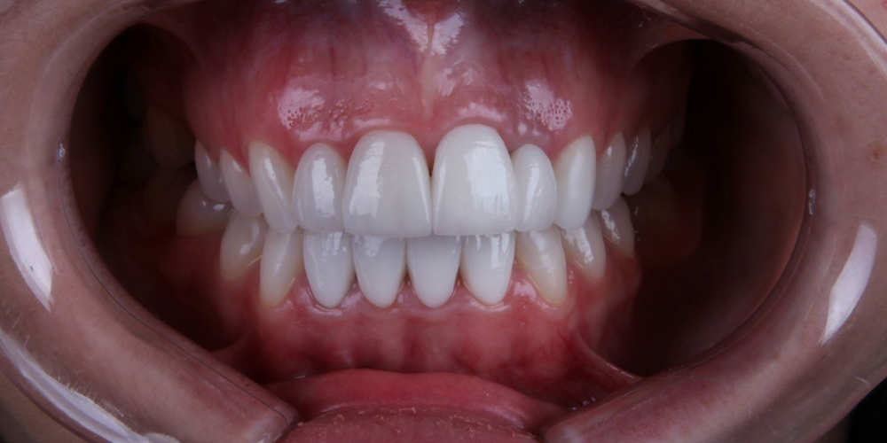 Исправление формы и цвета передних зубов при помощи виниров - фото №2
