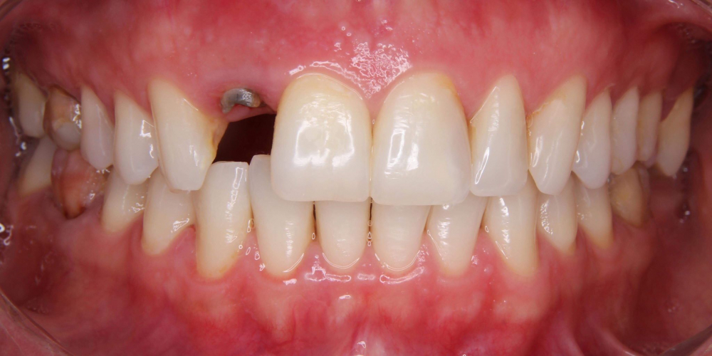 Пациентка обратилась с отломленным зубом ниже уровня десны - фото №1