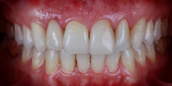 Пациентка обратилась с отломленным зубом ниже уровня десны - фото №3