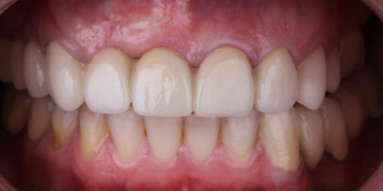Жалобы на эстетику передних зубов, новый металлокерамический мост - фото №9