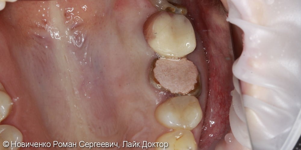 Аутотрансплантация (пересадка зуба) - фото №1