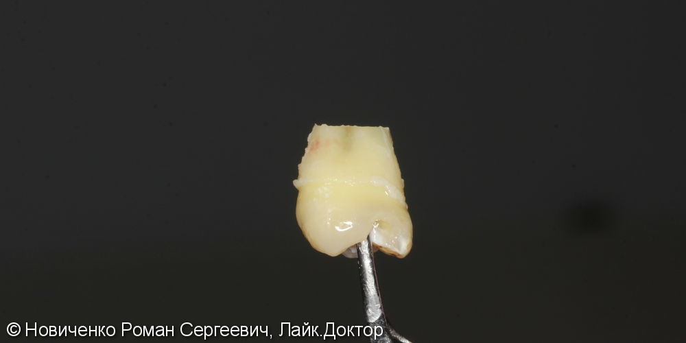 Аутотрансплантация (пересадка зуба) - фото №2