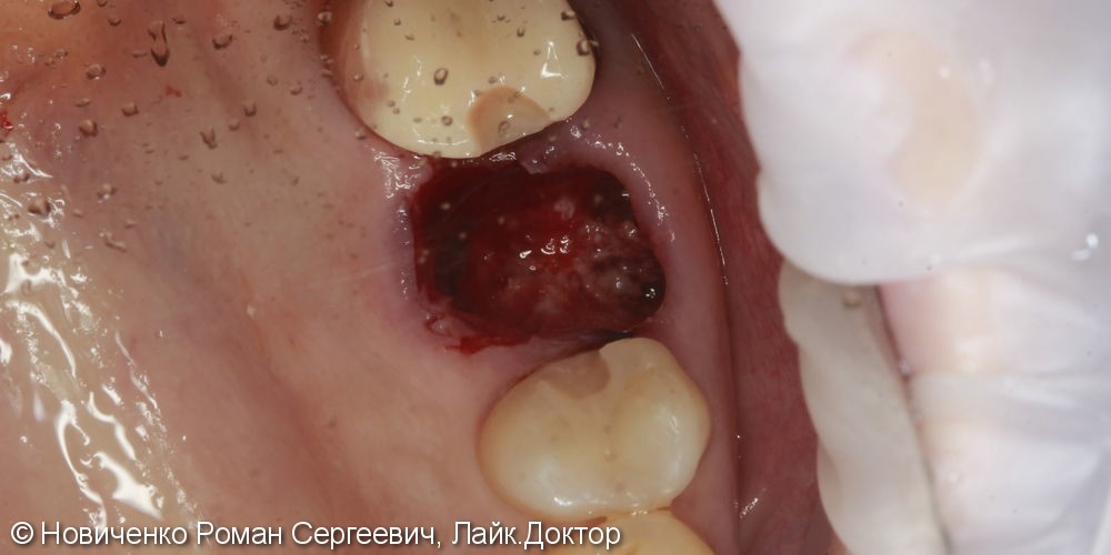 Аутотрансплантация (пересадка зуба) - фото №3