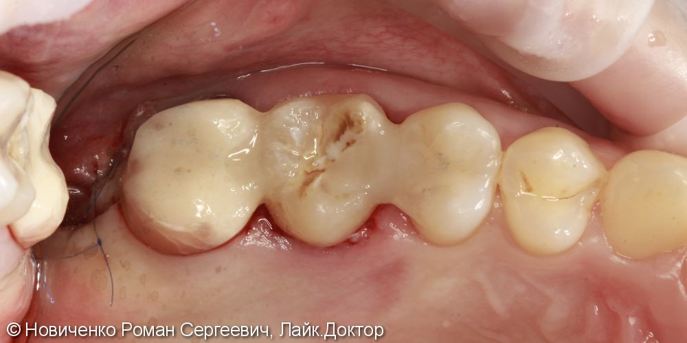 Аутотрансплантация (пересадка зуба) - фото №4