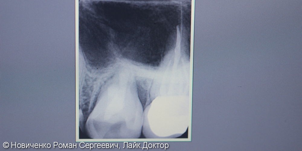 Аутотрансплантация (пересадка зуба) - фото №5