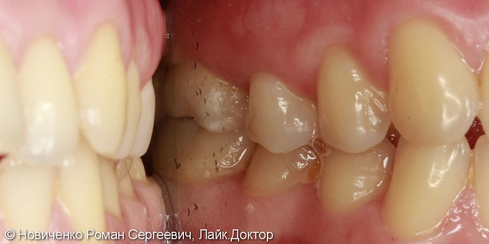 Аутотрансплантация (пересадка зуба) - фото №6