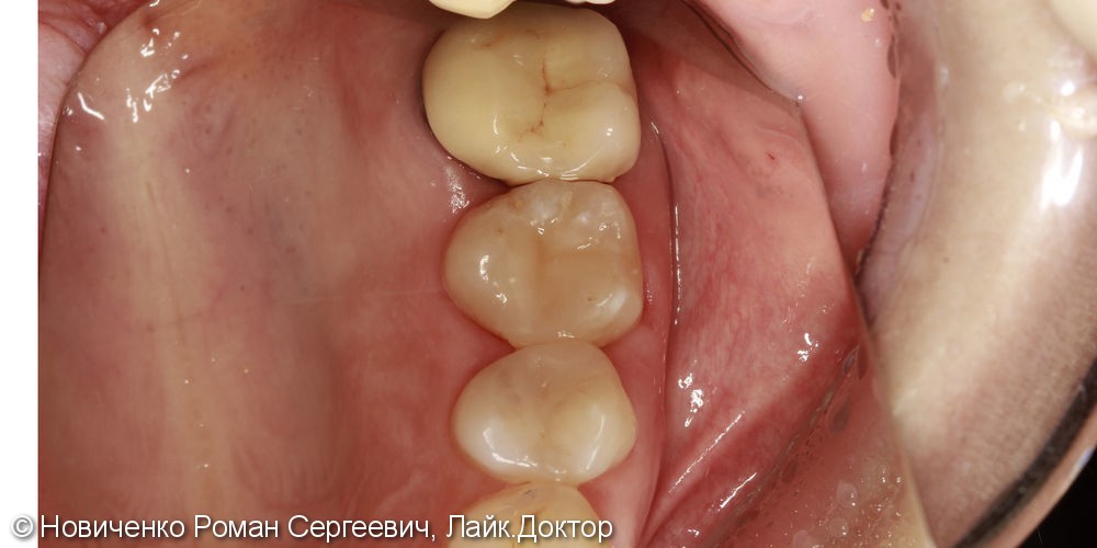 Аутотрансплантация (пересадка зуба) - фото №7