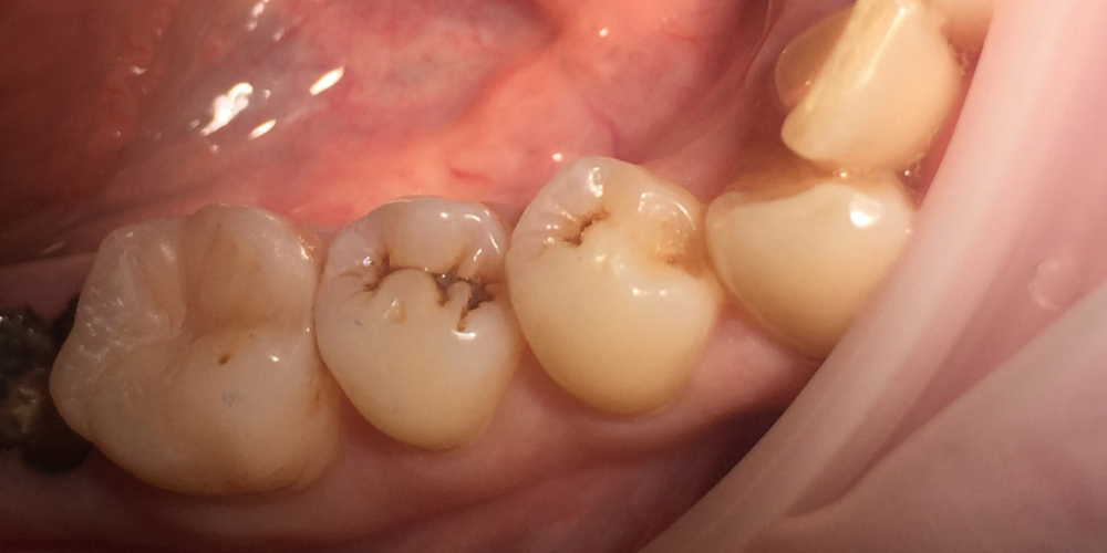 Восстановление зуба по 1 классу Блэка фотопломбой - фото №1