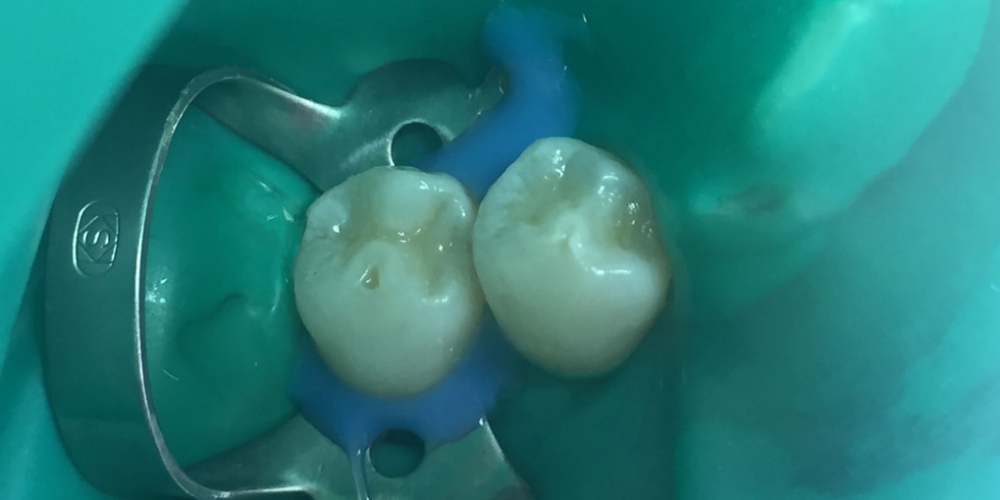 Восстановление зуба по 1 классу Блэка фотопломбой - фото №2