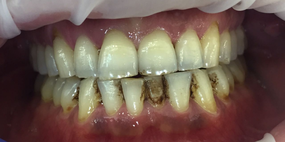 Жалобы на кровоточивость дёсен и зубные отложения - фото №1