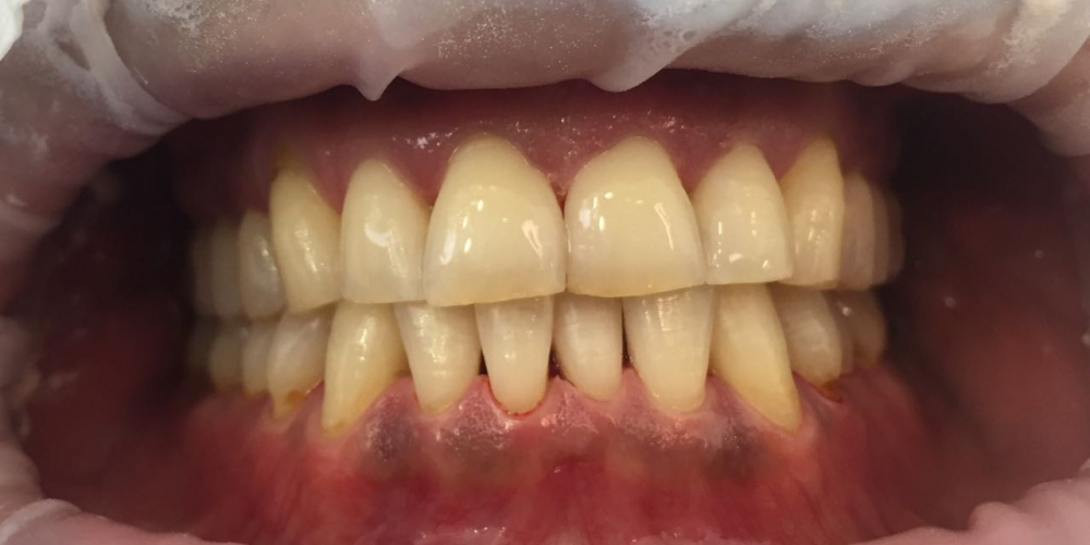 Жалобы на кровоточивость дёсен и зубные отложения - фото №2