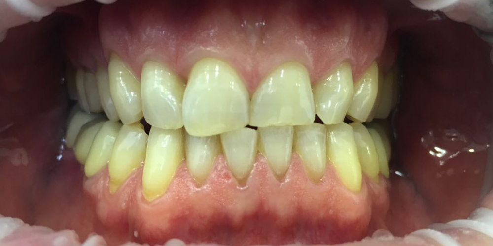 Офисное отбеливание зубов Системой Opalessens - фото №1