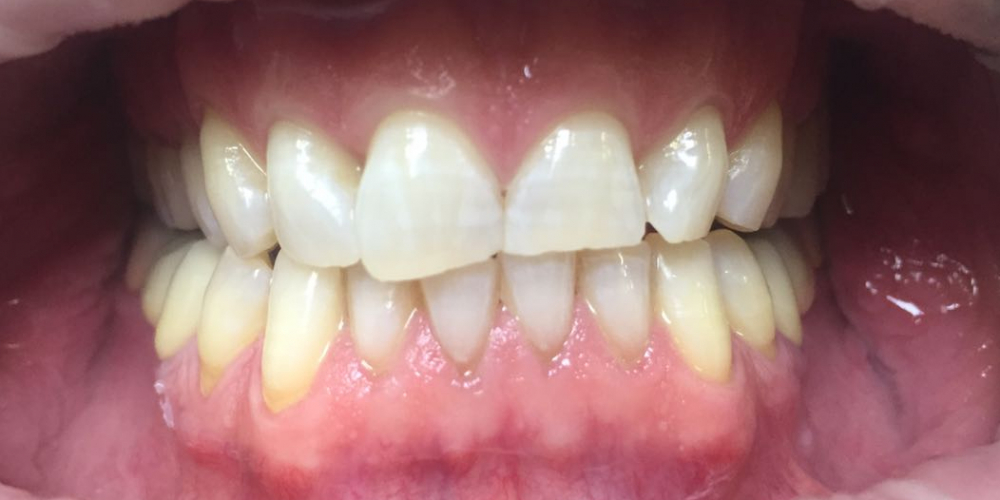 Офисное отбеливание зубов Системой Opalessens - фото №2
