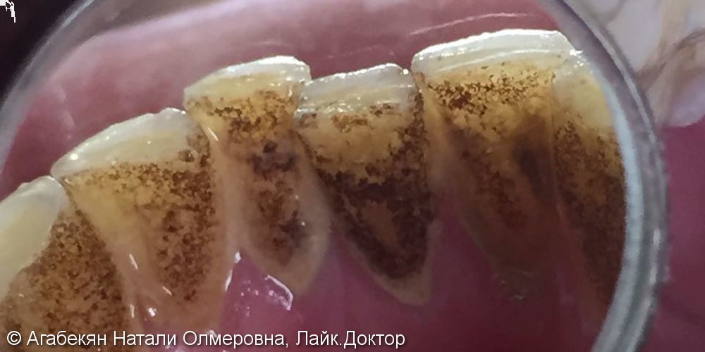 Жалобы на кровоточивость дёсен и зубные отложения - фото №1