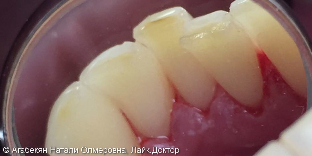 Жалобы на кровоточивость дёсен и зубные отложения - фото №2