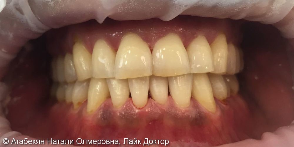Профессиональная гигиена: снятие твёрдых зубных отложений, пигментированого зубного налёта, глубокое фторирование - фото №2