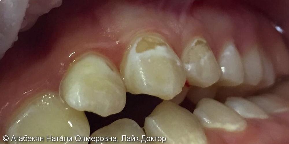 Исправление эстетического дефекта в области зубов 23 и 24 - фото №1