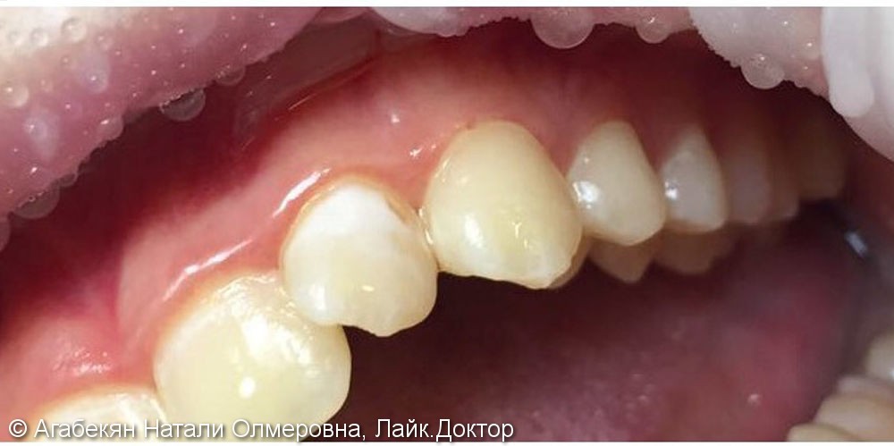 Исправление эстетического дефекта в области зубов 23 и 24 - фото №2