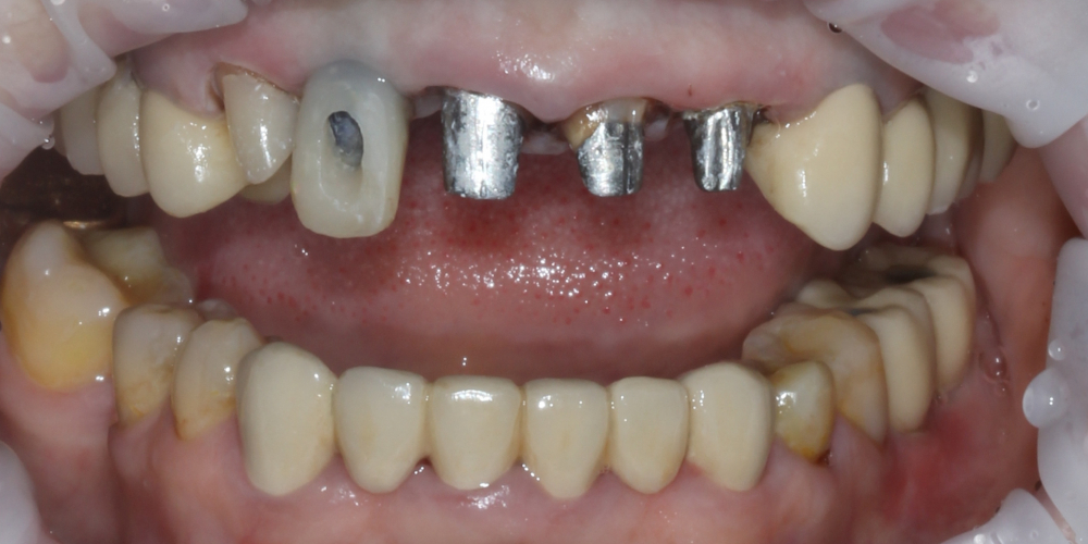 Протезирование 4х зубов и протезирование имплантата в области 12 зуба - фото №1