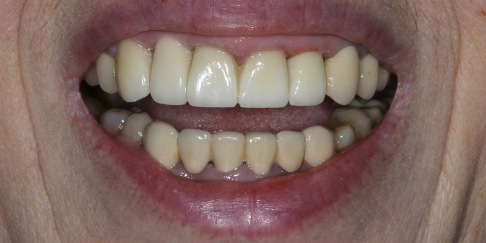 Протезирование 4х зубов и протезирование имплантата в области 12 зуба - фото №2