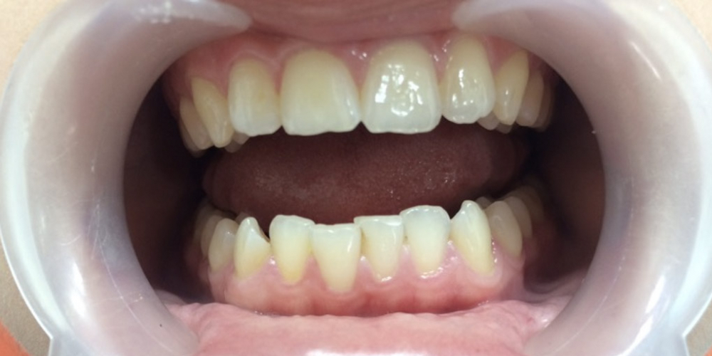 Исправление скрученности зубов на нижней челюсти - фото №1