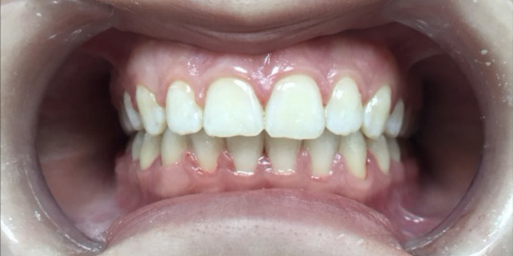 Исправление скрученности зубов на нижней челюсти - фото №2