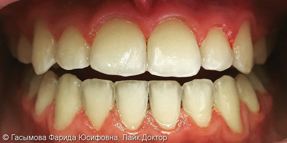 Ортодонтическое лечение на брекет системе Damon Q - фото №1