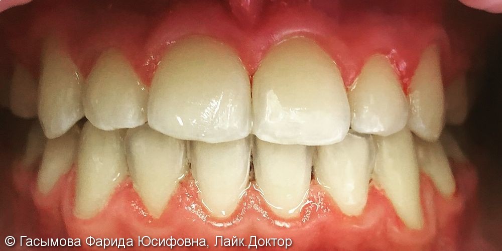 Ортодонтическое лечение на брекет системе Damon Q - фото №3