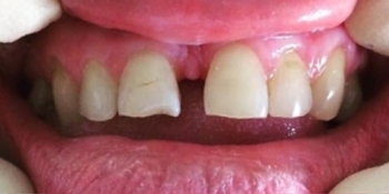 Устранение щели между передних зубов с помощью виниров - фото №1