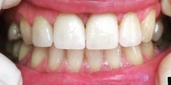 Устранение щели между передних зубов с помощью виниров - фото №2