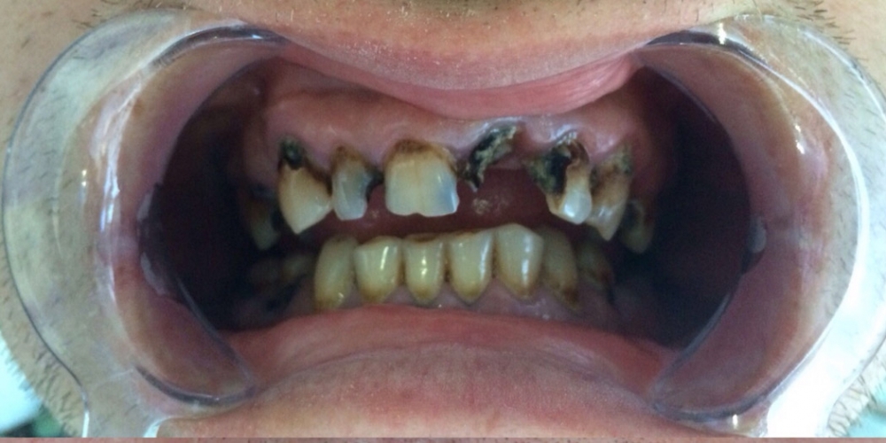 Восстановления жевательной и эстетической функции зубов - фото №1