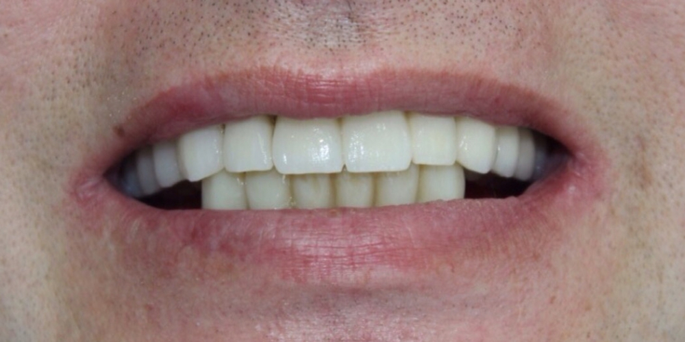 Восстановления жевательной и эстетической функции зубов - фото №2