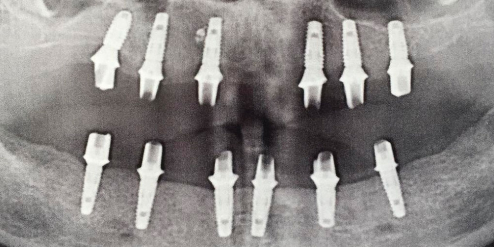 Протезирование металлокерамическими коронками на имплантатах при полном отсутствии зубов - фото №1
