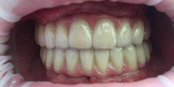 Протезирование металлокерамическими коронками на имплантатах при полном отсутствии зубов - фото №6