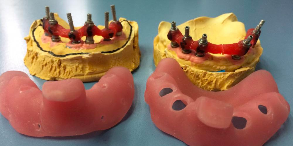 Протезирование металлокерамическими коронками на имплантатах при полном отсутствии зубов - фото №3