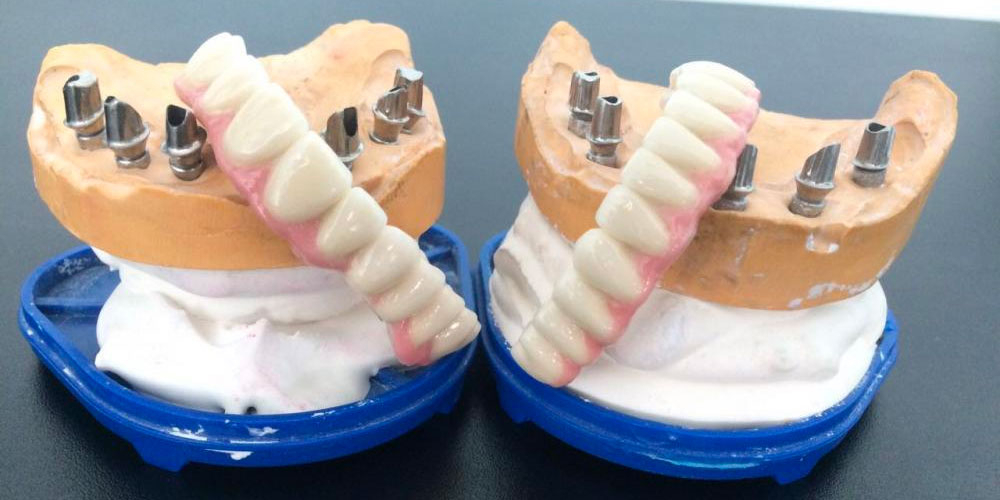Протезирование металлокерамическими коронками на имплантатах при полном отсутствии зубов - фото №5