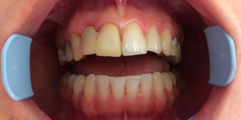 Протезирование цельнокерамическими коронками фронтальной группы зубов - фото №1