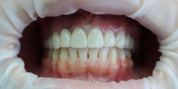 Протезирование цельнокерамическими коронками фронтальной группы зубов - фото №2