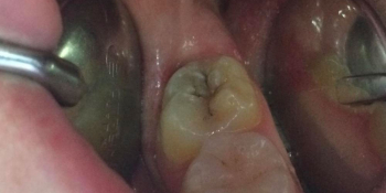 Лечение кариеса жевательного зуба - фото №1