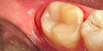 Лечение кариеса жевательного зуба - фото №4