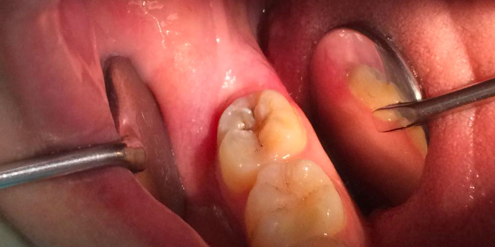 Лечение кариеса жевательного зуба - фото №3
