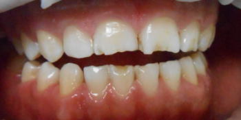 Реставрация керамическими винирами E-max (двух верхних и нижних зубов) - фото №1
