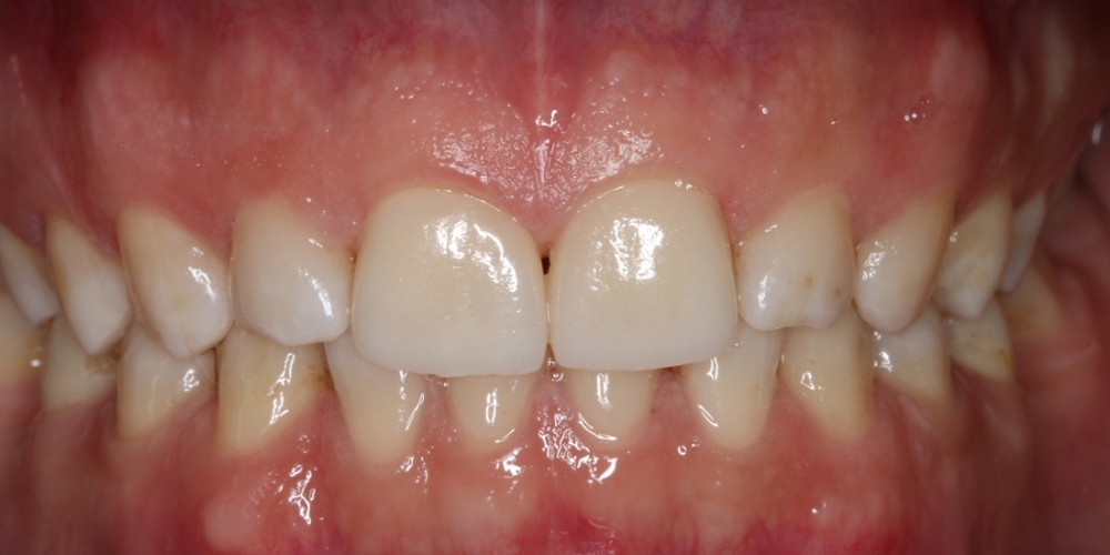 Реставрация керамическими винирами E-max (двух верхних и нижних зубов) - фото №3